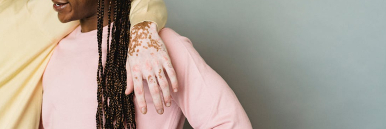 Stay Vigilant! Unveiling the Four Stages of Vitiligo