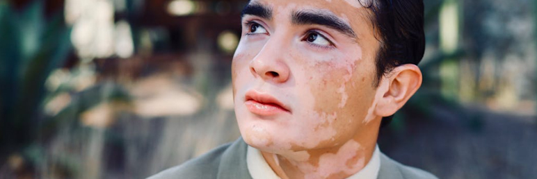 Key Points to Enhance the Effectiveness of 308 Laser Treatment