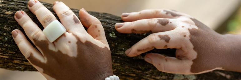 Is itching in the white patches a good or bad thing?